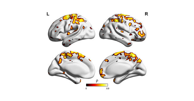 Tutkittavilla, joilla amyloidia oli vasta alkanut kertyä, amyloidin ja neuroinflammaation väliltä löydettiin yhteys niiltä aivoalueilta, jonne amyloidia alkaa ensimmäiseksi kerääntyä Alzheimerin taudissa (näkyvät kuvassa väritettyinä).
