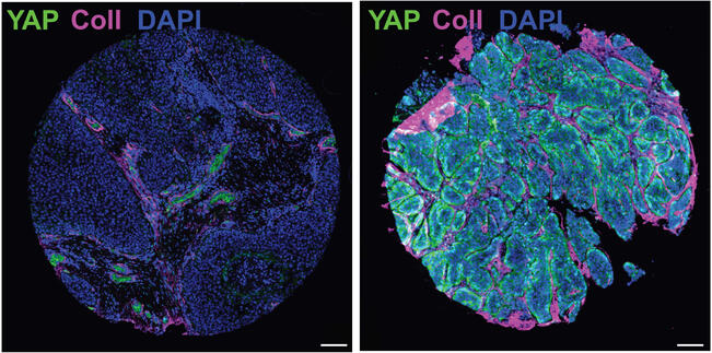 Mikroskooppikuvat kahdesta ihmisen kurkunsyöpäkasvaimesta, jossa syöpäsolut (YAP-proteiinin ilmenemistä osoittava vihreä väri) ovat jäykän sidekudosrikkaan kudoksen (puna-valko-violetti) ympäröimänä. Vasemmalla varhaisen vaiheen kasvain ja oikealla pitkälle edennyt syöpäkasvain. 
