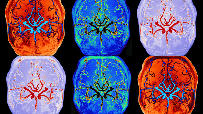 Aivojen nesteiden liikkeen vilkastumista unen aikana voidaan seurata nopeasti ja turvallisesti ilman varjoaineita.